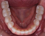 Fig 13. Post-treatment, occlusal view of mandibular
arch.
