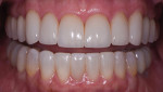 Fig 14. Post-treatment, close-up view of teeth apart.