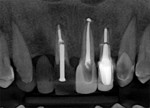 Fig 1. Radiographs taken at initial visit showed
previously endodontically treated anterior teeth
and a ceramic bridge on Nos. 6 through 8.