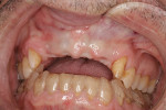 Fig 6. Maxillary arch following healing of the extraction sites at Nos. 8 through 10. Clear aligner is shown on the mandibular arch at completion of
orthodontics on that arch.