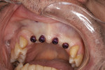 Fig 12. Healing abutments placed on
the implants.