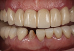 Fig 2. Frontal view of missing crown, mandibular right lateral incisor.