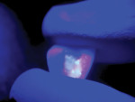 Fig 4. An ultraviolet (UVA) LED light aided in detecting the fluorescent resin cement, which
had adhered to the intaglio surface of the debonded crown.