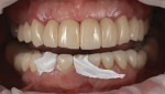 Fig 7. After isolating the adjacent teeth and air-thinning and lightcuring
the adhesive, resin cement was placed inside the debonded restoration, which was seated and tack-cured.