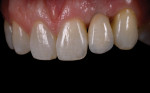 Fig 14. Delivery of cement-retained implant crown demonstrating minimal tissue
irritation following immediate clean-up of excess cement.