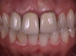Fig 15. Initial situation demonstrating cosmetic concerns with existing metal-ceramic crowns on the right lateral incisor,
right central incisor, and left lateral incisor, and recurrent decay on the left lateral incisor of the maxilla.