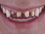 Fig 16.
Sectioned and removed restorations/decay revealing clinically short tooth preparations.