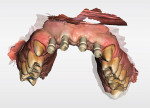Fig 13. Scan of the scan bodies on the implants to be used for the design and fabrication of the custom abutments.