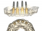 Fig 14. Virtual design of the implant abutments (top, frontal view; bottom, occlusal view). Their
design process was aided by using scans of the patient’s existing tissue status and biocopies
of the provisionals.