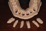 Fig 16. The Geller
model enabled the removal of dies at teeth Nos. 6 and 11 and implant custom abutments at Nos.
7 through 10 to facilitate the finishing of the restorations that will be fabricated at each site.