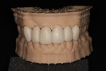Fig 18. Individual lithiumdisilicate
CAD provisional crowns were designed and milled for Nos. 6 through 11 and finished on
the previously printed model.