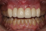 Fig 21. Provisional lithium-disilicate ceramic individual crowns placed intraorally
on Nos. 6 through 11 and luted in with temporary cement. Soft tissue would be allowed to mature in preparation for the final crowns.