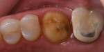 Fig 6. Case 2, tooth preparation No. 3.
