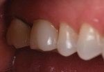 Fig 10. Final restoration, buccal view.