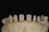 Figure 19  A radiograph taken after 46 months in function demonstrates the stability of the crestal peri-implant bone around both implants.