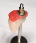 Fig 1. A dermal al­lograft was adapted around a screw-­retained provl­slonal crown using the Derma Apron Technique.