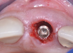 Fig 2. Immediate Implant placement with a palatal bias.