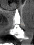 Fig 3. CBCT scan of inverted body design implant demonstrating pres­ence of thick facial bone, particularly at the level of the implant platform.