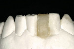 Figure 2  Buccal view of the model, showing the pontic wax-up.