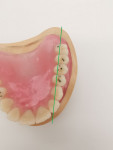Fig 14 and Fig 15. Setting up the posterior teeth in the maxilla with a silicone key and checking the profile of the basal static line to the central fissures.