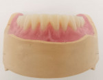 Fig 19 and Fig 20. The muscle-gripping design of the denture bodies and creation of the palatal folds.