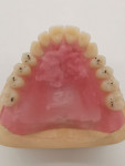 Fig 19 and Fig 20. The muscle-gripping design of the denture bodies and creation of the palatal folds.