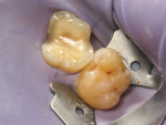Fig 4. Immediate dentin
sealing on tooth No. 3.