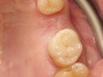 Fig 5. Ceramic onlay restoration on tooth No. 3.