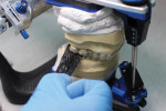 Fig 11. Occlusal
check using articulating paper.