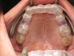 Fig 15. 3D-printed flexible splint in patient’s mouth.