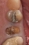 Fig 1. Tooth No. 13 pre-extraction.