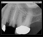 Fig 7. Periapical radiograph, pre-extraction of tooth No. 13.