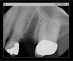 Fig 8.
Periapical radiograph, immediate post-extraction.