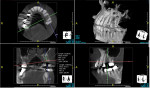 Fig 10. Initial CBCT
scan to examine bone conditions prior to implant placement procedure.