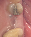 Fig 12. Surgical site (No. 13) 6 months after healing.