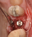 Fig 14. Implant placement (after guide pin
placement [not shown] had been done to verify angulation).