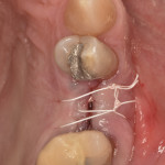 Fig 15. Surgical closure of site.