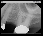 Fig 16. Periapical radiograph, surgical site (No. 13)
6 months after extraction and ARP.