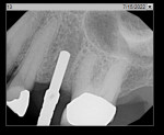 Fig 17. Periapical radiograph showing initiation of osteotomy.