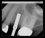 Fig 18. Periapical radiograph showing osteotomy
prior to implant placement.