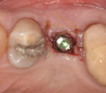 Fig 20. Second-stage implant uncovery, occlusal view.