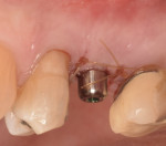 Fig 21. Secondstage
implant uncovery, buccal view.