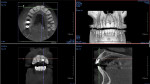 Fig 3. Pre-treatment CBCT imaging.