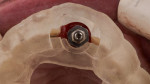 Fig 7. Fully guided implant placement using the dual-purpose surgical guide.