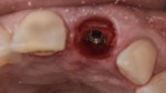 Fig 8. Palatal implant placement with buccal gap grafting.