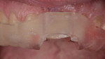 Fig 10. The patient’s decoronated tooth positioned using the dual-purpose surgical guide, buccal view.