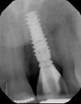 Fig 11. Post-treatment periapical radiograph.