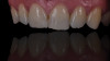 Figure 41  Right lateral view of patient’s postoperative natural smile.