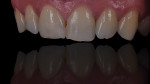 Figure 1  Single central restoration on tooth No. 8 using GC Initial MC. The skill level achieved is through deep practice and an understanding of the ceramic system.