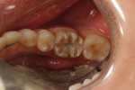 (2.) Initial depth cuts were placed to ensure a proper occlusal reduction of 1 mm.